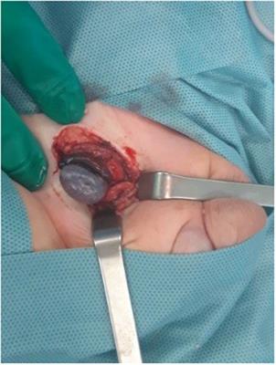 torsion testicular cryptorchidism frontiersin pediatric patients
